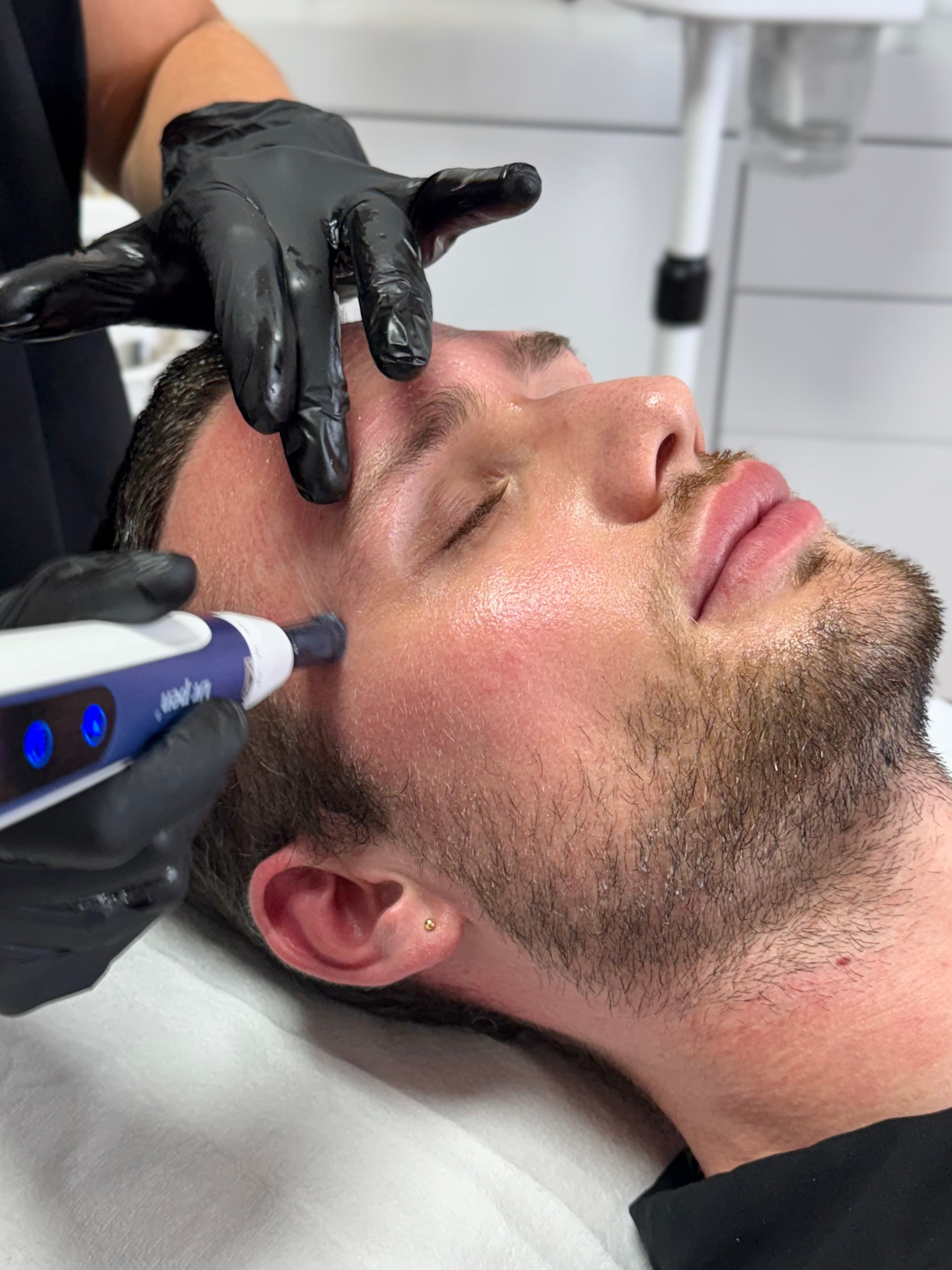 Microneedling